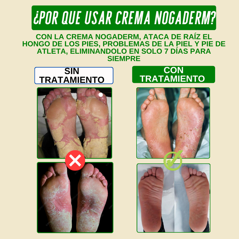 Pies Sanos en 7 días, Crema reparadora Nogaderm +🎁Guía digital de bienestar de regalo