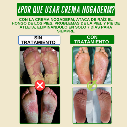 Pies Sanos en 7 días, Crema reparadora Nogaderm +🎁Guía digital de bienestar de regalo
